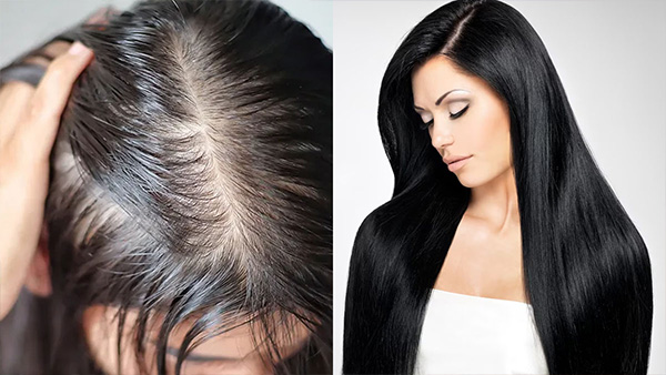 How Do You Regrow Thinning Hair Crowns In Tamil 