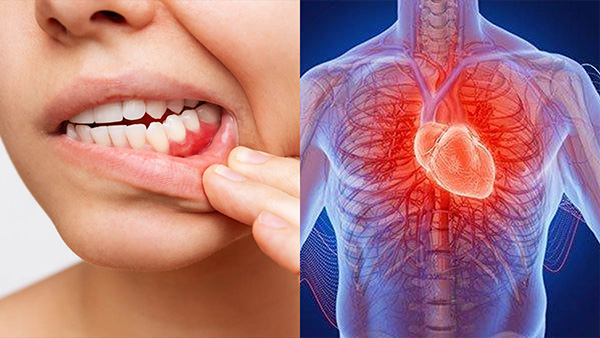 How Is Gum Disease Linked To Heart Problems In Tamil How Is Gum Disease Linked To Heart Problems In Tamil