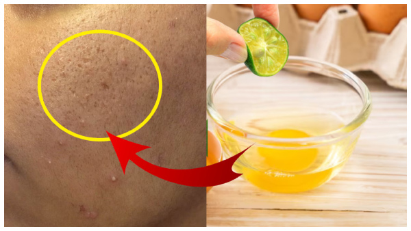 Skin Care Tips: Home Remedies To Reduce Pores on Face In Tamil