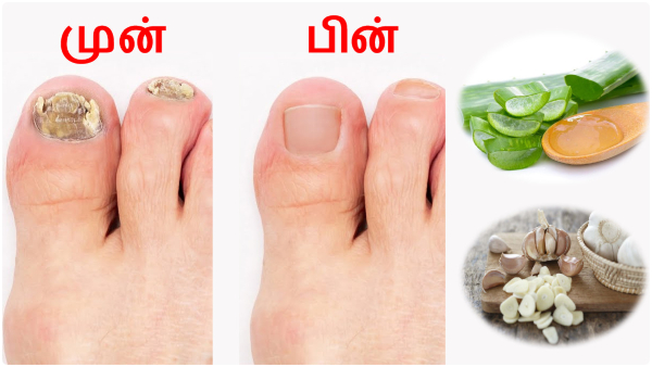 How To Get Rid Of Toenail Fungus In Tamil
