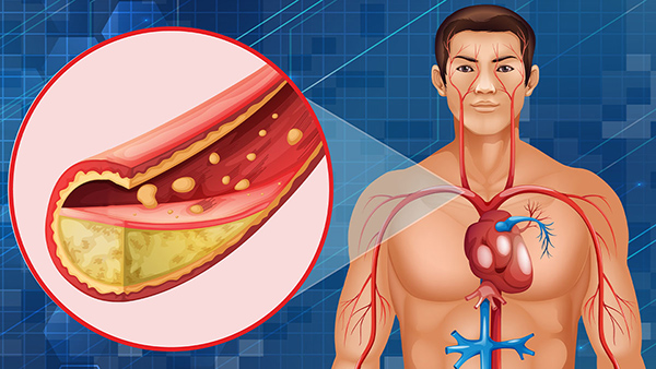 How Bad Cholesterol Affects Heart Health In Tamil 