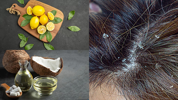 Does Coconut Oil And Lemon For Dandruff Actually Work In Tamil 