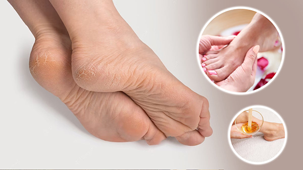 Foot Packs To Get Rid Of Dry Foot Skin In Tamil 