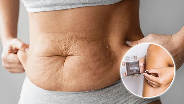 Home Remedies To Get Rid Of Cellulite Naturally In Tamil 