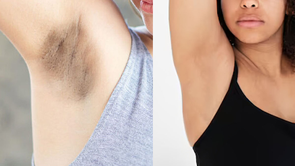 How To Get Rid Of Armpit Hair Naturally In Tamil 