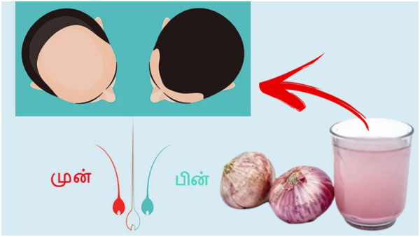 Hair Care Tips: Ways To Use Onion Juice For Promoting Healthy Hair Growth In Tamil Hair Care Tips: Ways To Use Onion Juice For Promoting Healthy Hair Growth In Tamil