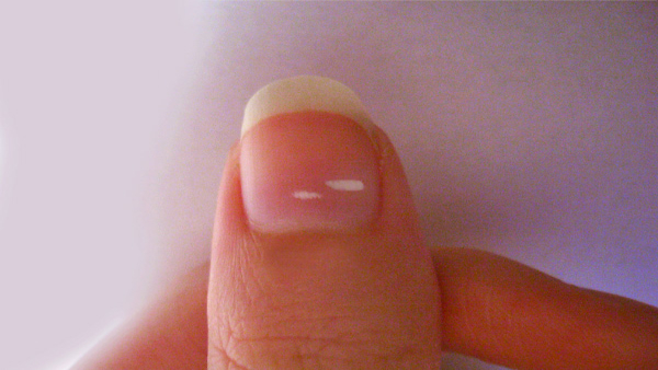 What Are the Causes of White Spots on Your Nails in Tamil