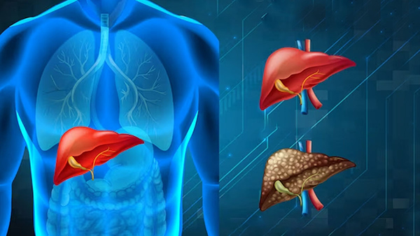Indian Foods That Can Lead To Fatty Liver Disease In Tamil 