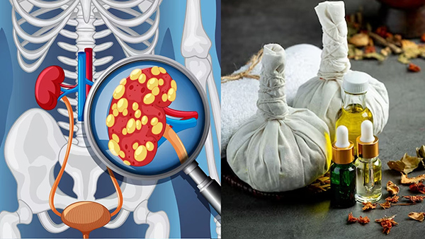 Ayurvedic Home Remedies For Kidney Disease In Tamil 