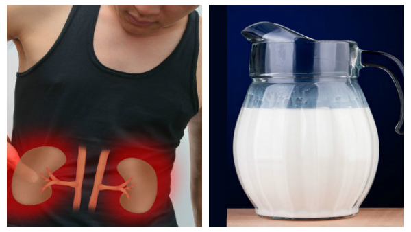 Myths and Facts About Kidney Stones in Tamil