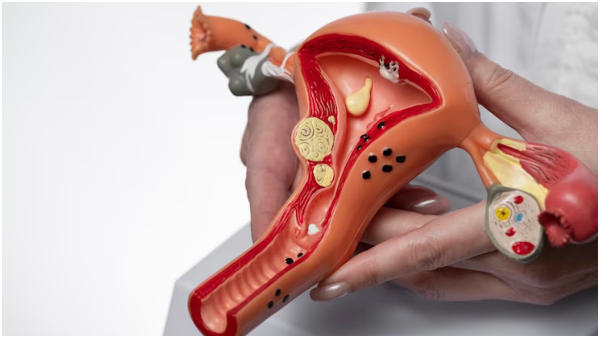 How To Shrink And Kill Ovarian Cysts In Tamil