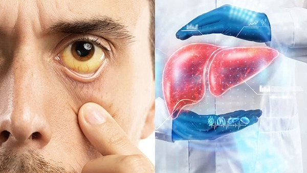 Signs of Liver Disease On Your Face in Tamil