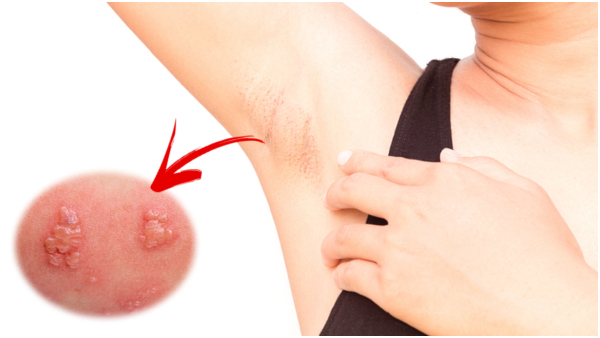 All You Need To Know About Hidradenitis Suppurativa In Tamil