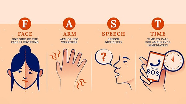 Brain Stroke Symptoms in Women in Tamil