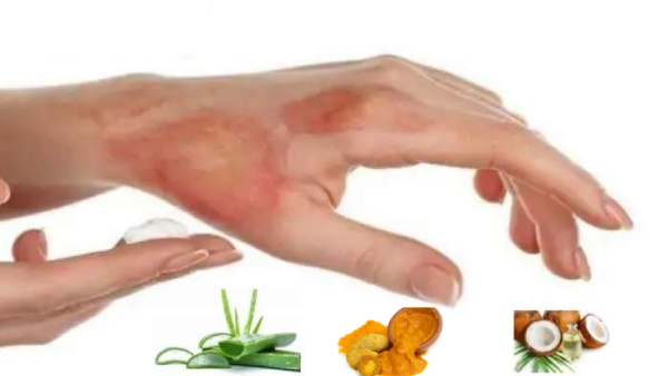 Ayurveda Remedies To Heal A Burn At Home In Tamil 
