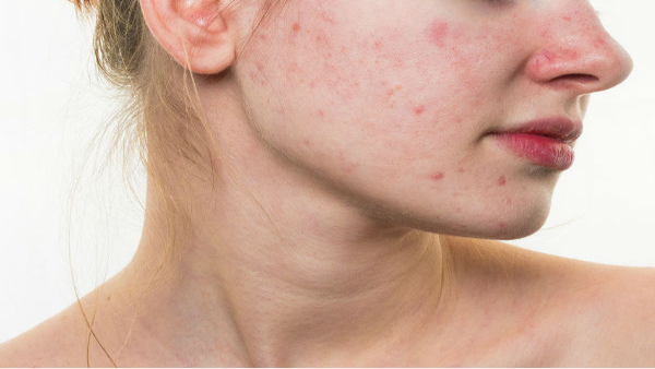 Home Remedies For Chin Pimples In Tamil 