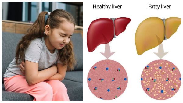 Fatty Liver Disease in Children is On the Rise In Tamil Fatty Liver Disease in Children is On the Rise In Tamil