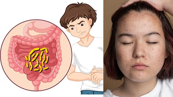 How Your Gut Health Affect Your Skin in Tamil