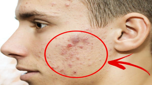 Ways To Deal With Pimple Full Of Pus In Tamil 