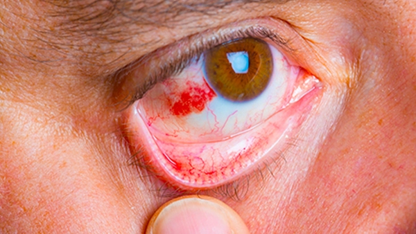Red Eyes Could Be a Symptom of This Silent Killer Condition in Tamil