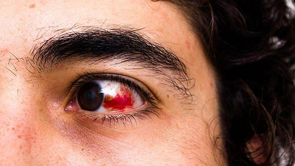 Red Eyes Could Be a Symptom of This Silent Killer Condition in Tamil