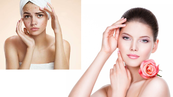 Skin Care Tips In Tamil: Turmeric And Rose Water For Pimples And Dry Skin