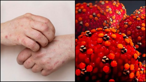 Tips To Keep Your Child Safe From Tomato Flu In Tamil