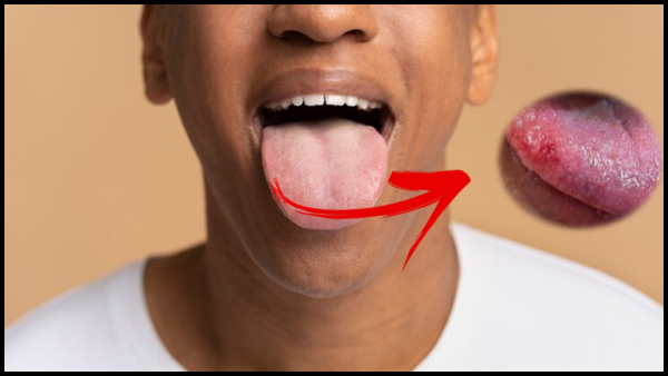 Natural Remedies for Tongue Bites In Tamil