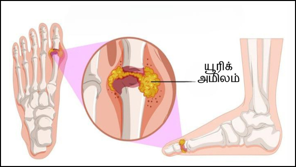 foods-to-reduce-uric-acid-levels