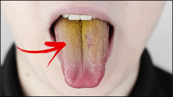 Yellow Tongue Reasons: Top 5 Diseases That Change Your Tongue Into Yellow Colour In Tamil