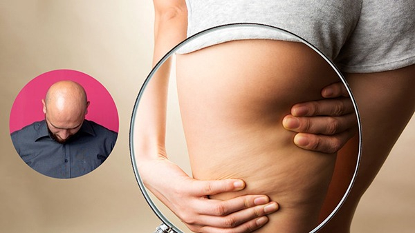 Bald Treatment: Scientists say injections of fat from your thighs could reverse the process in Tamil Bald Treatment: Scientists say injections of fat from your thighs could reverse the process in Tamil