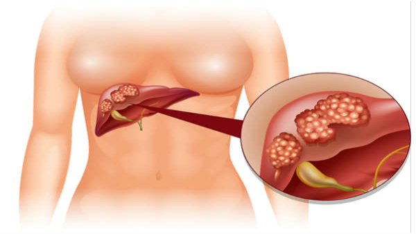 Symptoms and Prevention Tips of Primary Liver Cancer in Tamil