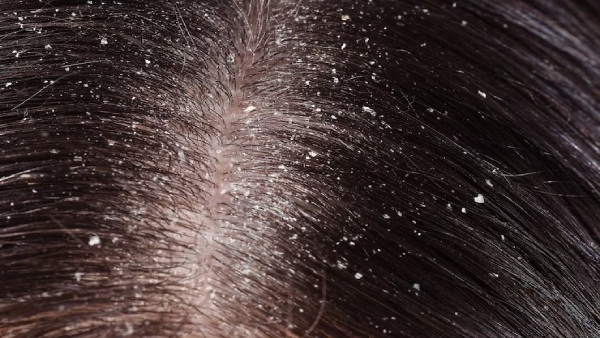 Tips To Manage Sebum To Prevent Dandruff In Tamil 