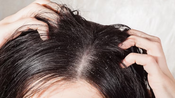 Tips To Manage Sebum To Prevent Dandruff In Tamil 