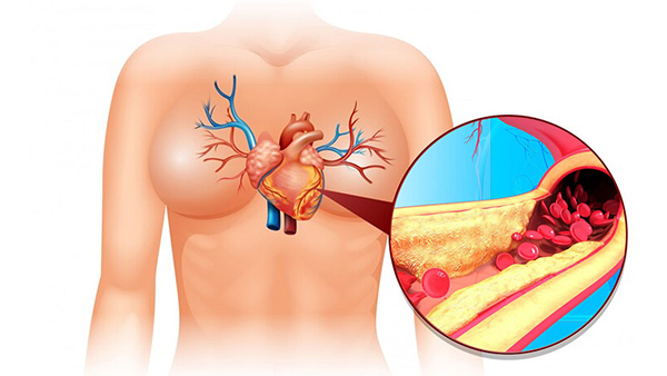 Drinks To Have On An Empty Stomach To Reduce Bad Cholesterol In Tamil 