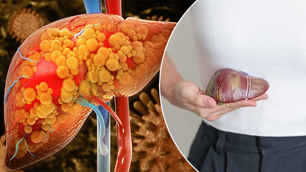 Can Non-Alcoholic Fatty Liver Trigger Liver Cancer And Failure In Tamil 