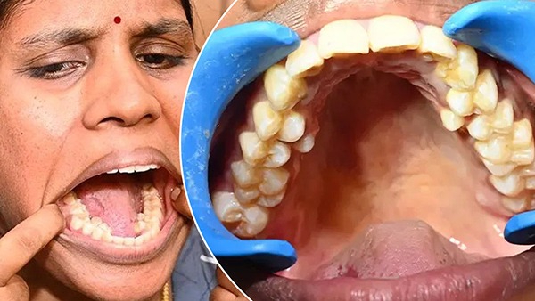 Tamilnadu Woman Kalpana Balan With 38 Teeth Earns Guinness World Record in Tamil