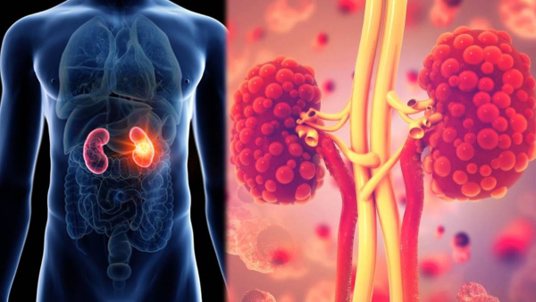 Diet Tips To Reduce Creatinine Levels For Healthy Kidneys In Tamil 