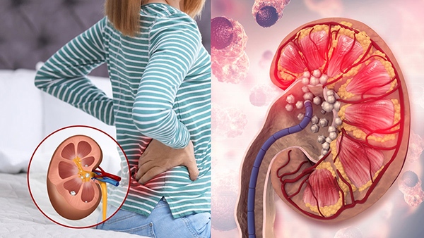 Diet Tips To Reduce Creatinine Levels For Healthy Kidneys In Tamil 