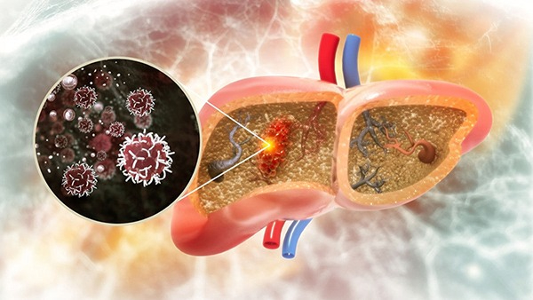 Symptoms and Prevention Tips of Primary Liver Cancer in Tamil