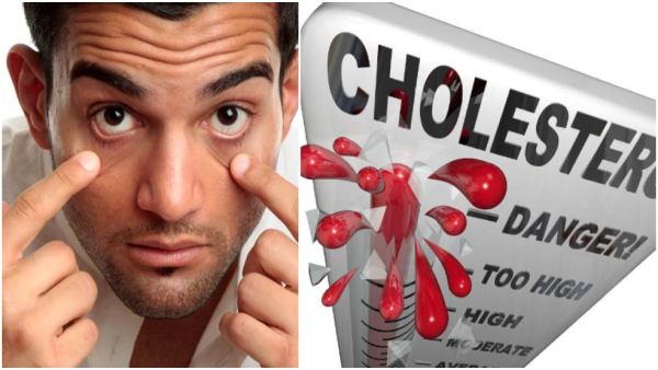 Signs of High Cholesterol in Your Eyes in Tamil