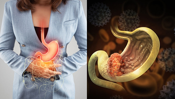 Habits That Can Lead To Stomach Cancer In Tamil Habits That Can Lead To Stomach Cancer In Tamil