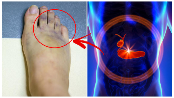 Pancreatitis Symptoms: Damaged Pancreas Signs That May Appear on Your Legs or Feet In Tamil