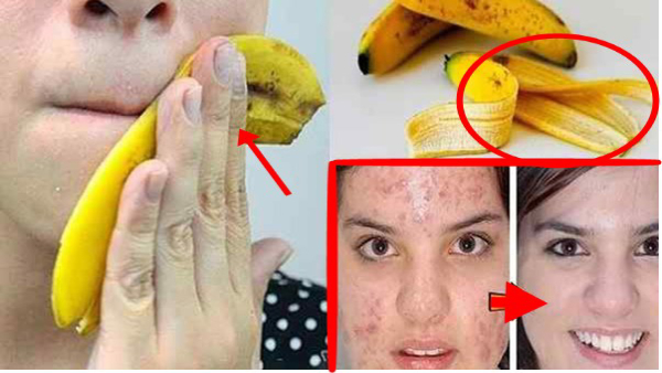 How to use banana peel for psoriasis treatment in tamil 