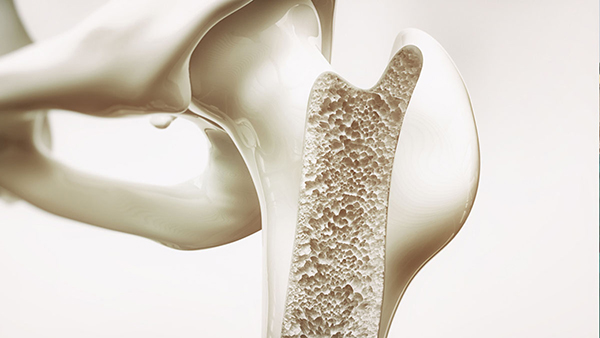 Healthy Eating Habits to Prevent Osteoporosis in tamil 