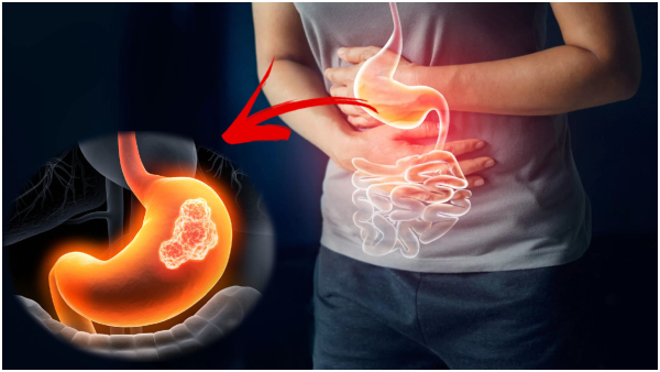 Why Stomach Cancer Cases Are Rising In India In Tamil