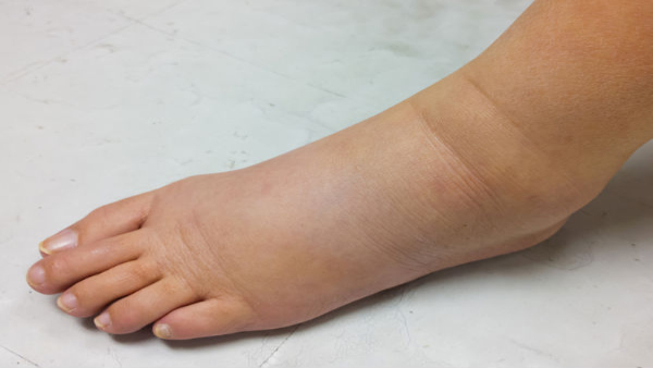 Causes of Swelling in Feet in Tamil