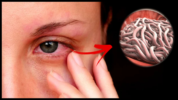 China Doctors Remove 60 Live Worms From Womans Eyes