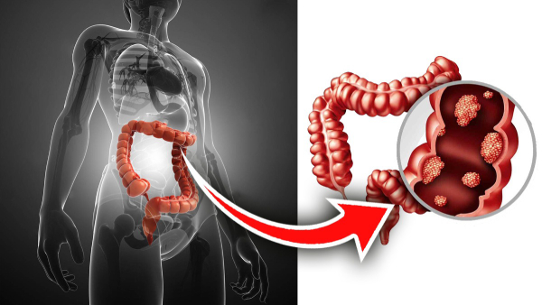 Lifestyle Habits That Lead to Colon Cancer in Youngsters in Tamil