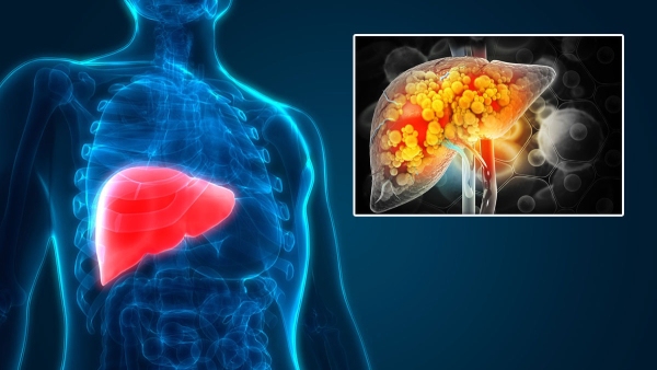 Adding these ingredients to warm water may help heal Fatty Liver in tamil Adding these ingredients to warm water may help heal Fatty Liver in tamil